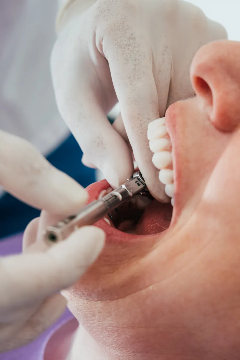 Dental Implants
