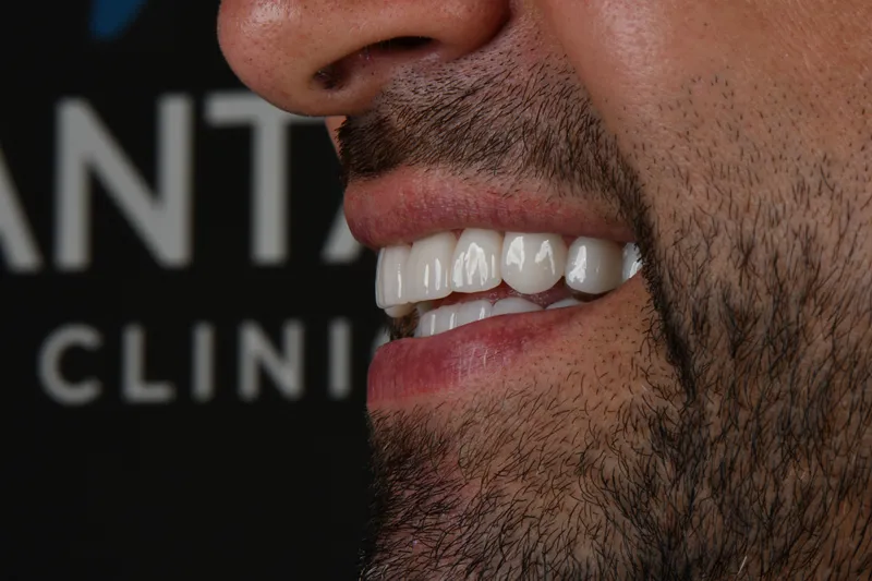 Zirconium Crowns