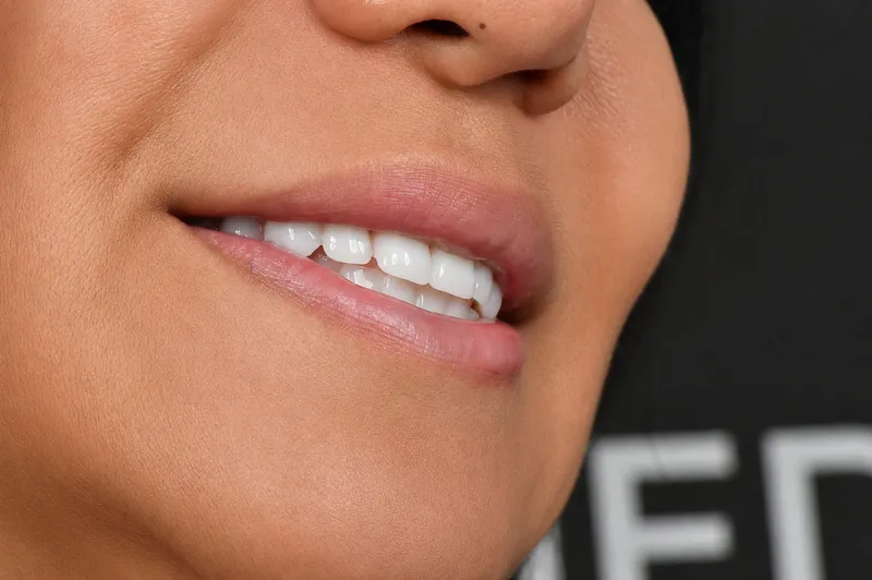 Zygoma Implants