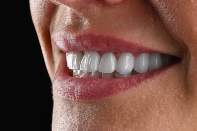 Zirconium Crowns 3