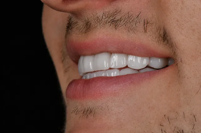 Zirconium Crowns 5