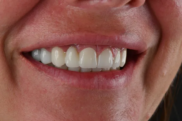 Zirconium Crowns 7