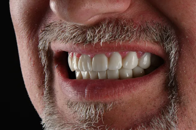 Zirconium Crowns 9